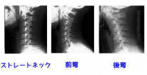 頸椎Ｘ線写真